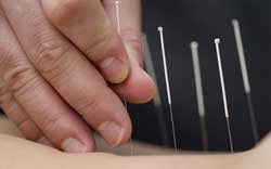 Acupuncture