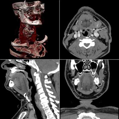 CT scans